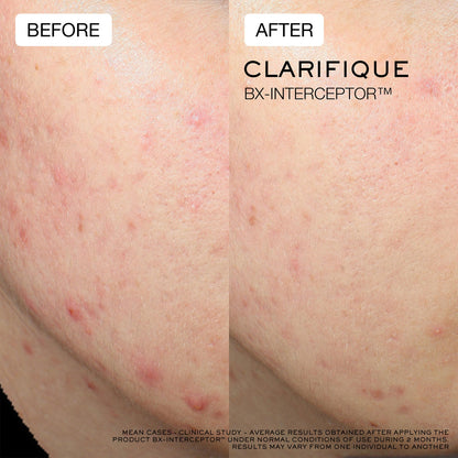 Clarifique Bx-Interceptor™ Acne Treatment