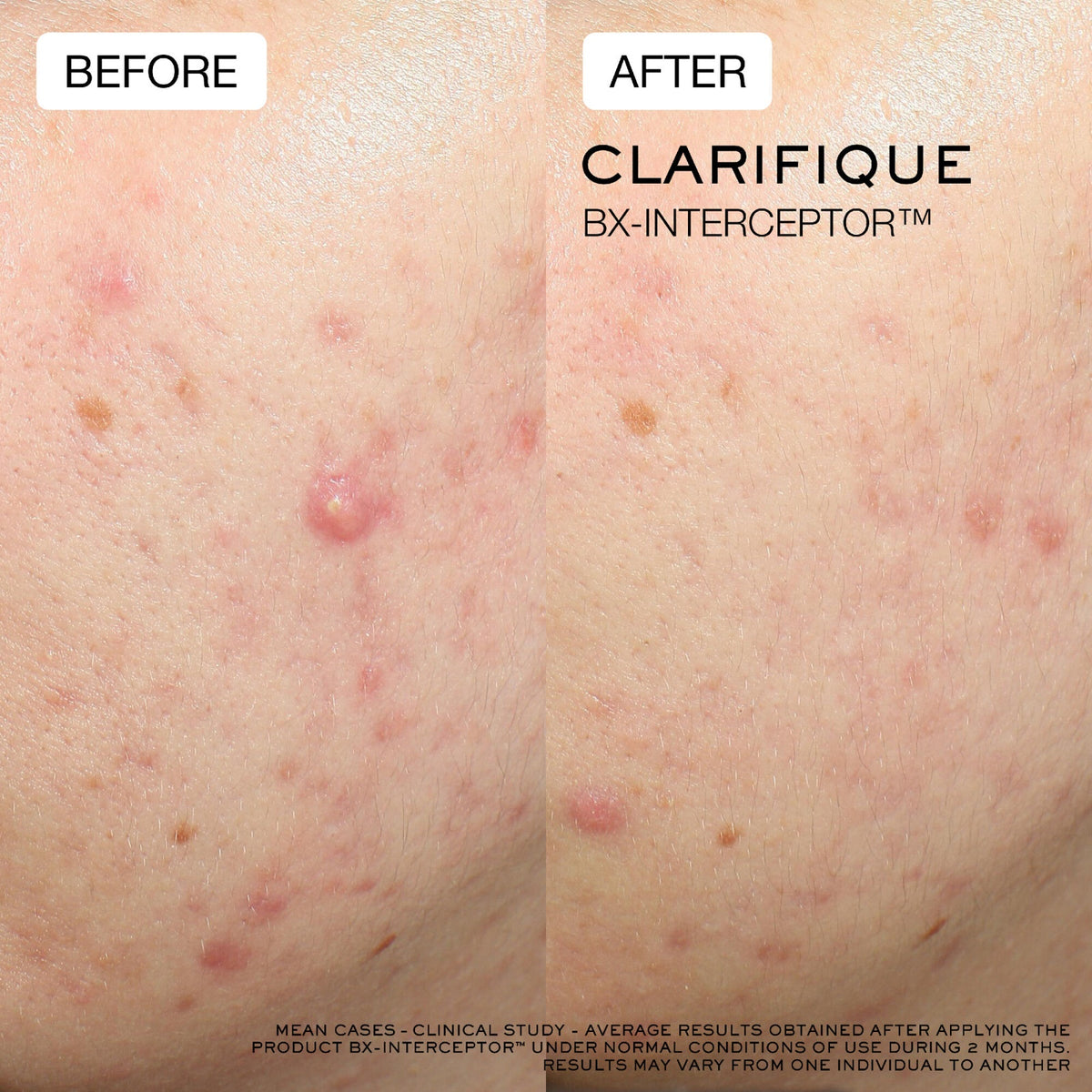 Clarifique Bx-Interceptor™ Acne Treatment