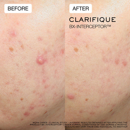 Clarifique Bx-Interceptor™ Acne Treatment